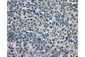 Immunohistochemical staining of paraffin-embedded Adenocarcinoma of ovary tissue N93ing anti-ARNT mouse monoclonal antibody. (ARNT Antikörper)