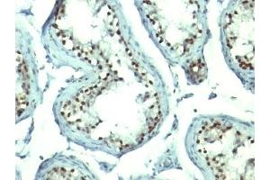Formalin-fixed, paraffin-embedded human testicular carcinoma stained with Nucleolin antibody. (Nucleolin Antikörper)