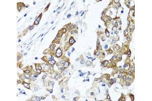 Immunohistochemistry of paraffin-embedded Human colon carcinoma using PPOX Polyclonal Antibody at dilution of 1:100 (40x lens). (PPOX Antikörper)