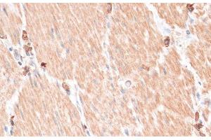 Immunohistochemistry of paraffin-embedded Human gastric cancer using ABCB7 Polyclonal Antibody at dilution of 1:100 (40x lens). (ABCB7 Antikörper)