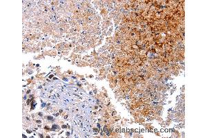 Immunohistochemistry of Human lung cancer using HMOX1 Polyclonal Antibody at dilution of 1:40 (HMOX1 Antikörper)