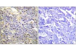 Immunohistochemistry analysis of paraffin-embedded human lung carcinoma tissue, using Caspase 9 (Ab-125) Antibody. (Caspase 9 Antikörper  (AA 91-140))