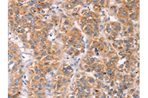 The image on the left is immunohistochemistry of paraffin-embedded Human liver cancer tissue using ABIN7191466(MLNR Antibody) at dilution 1/45, on the right is treated with synthetic peptide.