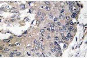 Immunohistochemistry analysis of ApoE Antibody in paraffin-embedded human lung carcinoma tissue. (APOE Antikörper)