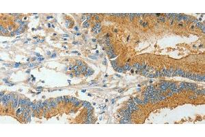 Immunohistochemistry of paraffin-embedded Human colon cancer using BAAT Polyclonal Antibody at dilution of 1:30 (BAAT Antikörper)