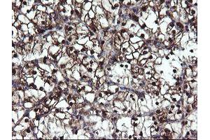 Immunohistochemical staining of paraffin-embedded Carcinoma of Human kidney tissue using anti-MPI mouse monoclonal antibody. (MPI Antikörper)