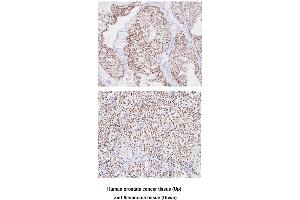 Paraffin embedded sections of human prostate cancer and seminoma tissue were incubated with anti-human TARDBP(1:50) for 2 hours at room temperature. (TARDBP Antikörper  (AA 1-260))