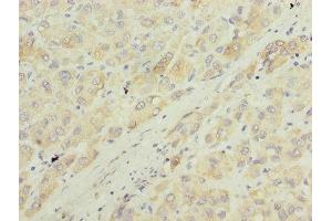 Immunohistochemistry of paraffin-embedded human liver cancer using ABIN7143985 at dilution of 1:100 (Monoamine Oxidase A Antikörper  (AA 1-300))