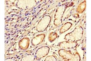 Immunohistochemistry of paraffin-embedded human gastric cancer using ABIN7170420 at dilution of 1:100 (SMOC1 Antikörper  (AA 277-382))