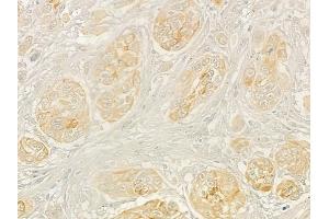 ABIN6263204 and ABIN6268937 at 1/100 staining human tongue carcinoma by IHC-P.