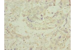 Immunohistochemistry of paraffin-embedded human pancreatic cancer using ABIN7159922 at dilution of 1:100 (MIPEP Antikörper  (AA 504-713))