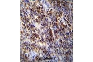 Parp9 Antibody (C-term) (ABIN655613 and ABIN2845094) immunohistochemistry analysis in formalin fixed and paraffin embedded human lymphoma followed by peroxidase conjugation of the secondary antibody and DAB staining. (PARP9 Antikörper  (AA 599-629))