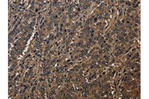 The image on the left is immunohistochemistry of paraffin-embedded Human liver cancer tissue using ABIN7129664(GSTO1 Antibody) at dilution 1/60, on the right is treated with fusion protein.