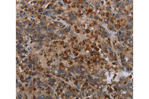 Immunohistochemistry of Human liver cancer using MAP3K11 Polyclonal Antibody at dilution of 1:40 (MAP3K11 Antikörper)