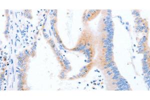 Immunohistochemistry of paraffin-embedded Human colon cancer using STK4 Polyclonal Antibody at dilution of 1:70 (STK4 Antikörper)