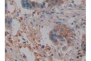 Detection of NGAL in Human Pancreatic cancer Tissue using Polyclonal Antibody to Neutrophil gelatinase-associated lipocalin (NGAL) (Lipocalin 2 Antikörper  (AA 21-198))
