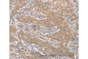 Immunohistochemistry of Human gastric cancer using NFE2L1 Polyclonal Antibody at dilution of 1:30 (NFE2L1 Antikörper)