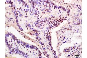 Formalin-fixed and paraffin embedded human colon carcinoma labeled Anti-THOC2 Polyclonal Antibody, Unconjugated (ABIN1387530) at 1:200, followed by conjugation to the secondary antibody and DAB staining (THO Complex 2 Antikörper  (AA 101-200))