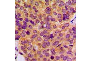 Immunohistochemical analysis of MMP19 staining in human breast cancer formalin fixed paraffin embedded tissue section. (MMP19 Antikörper  (N-Term))
