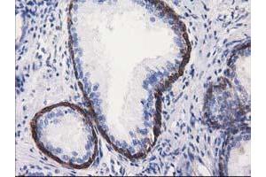 Immunohistochemical staining of paraffin-embedded Carcinoma of Human kidney tissue using anti-ALDH1L1 mouse monoclonal antibody. (ALDH1L1 Antikörper)