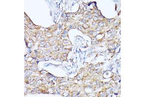 Immunohistochemistry of paraffin-embedded human breast cancer using CTSF antibody (ABIN6127667, ABIN6139225, ABIN6139226 and ABIN6214736) at dilution of 1:100 (40x lens). (Cathepsin F Antikörper  (AA 270-484))
