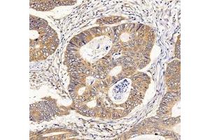 Immunohistochemistry of paraffin embedded human colon cancer using IFIT5 (ABIN7074334) at dilution of 1:500 (200x lens) (IFIT5 Antikörper)