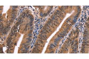 Immunohistochemistry of paraffin-embedded Human colon cancer using EVC2 Polyclonal Antibody at dilution of 1:40 (EVC2 Antikörper)