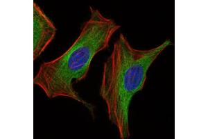 Immunohistochemical analysis of paraffin-embedded ovarian cancer tissues using Insulin Like Growth Factor 2 (IGF2) antibody with DAB staining. (IGF2 Antikörper  (AA 25-180))