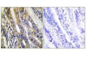 Immunohistochemistry analysis of paraffin-embedded human colon carcinoma tissue, using DGKH antibody. (DGKH Antikörper)