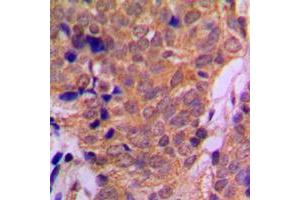 Immunohistochemical analysis of Histone Deacetylase 6 staining in human breast cancer formalin fixed paraffin embedded tissue section.