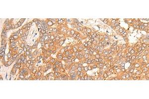 Immunohistochemistry of paraffin-embedded Human liver cancer tissue using CPS1 Polyclonal Antibody at dilution of 1:35(x200) (CPS1 Antikörper)