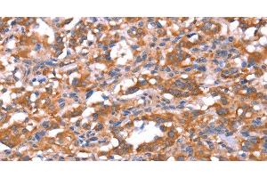 Immunohistochemistry of paraffin-embedded Human thyroid cancer tissue using FAM13B Polyclonal Antibody at dilution 1:30 (FAM13B Antikörper)