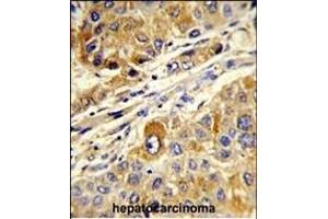 Forlin-fixed and paraffin-embedded hun hepatocarcino reacted with STL Antibody, which was peroxidase-conjugated to the secondary antibody, followed by DAB staining. (MASTL Antikörper)