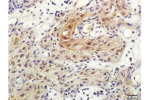 Formalin-fixed and paraffin embedded human vulvar cancer labeled with Anti-Rho C Polyclonal Antibody, Unconjugated (ABIN687157) followed by conjugation to the secondary antibody and DAB staining (RHOC Antikörper  (AA 101-193))