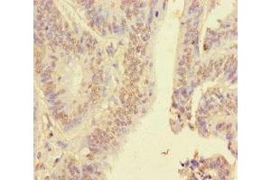 Immunohistochemistry of paraffin-embedded human colon cancer using ABIN7155138 at dilution of 1:100 (HNRNPA2B1 Antikörper  (AA 1-249))