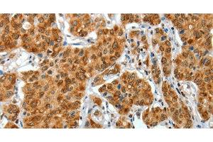 Immunohistochemistry of paraffin-embedded Human lung cancer tissue using COL1A2 Polyclonal Antibody at dilution 1:70 (COL1A2 Antikörper)