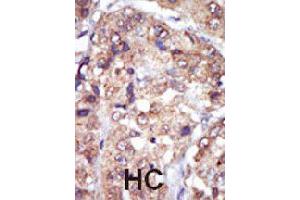 Formalin-fixed and paraffin-embedded human hepatocellular carcinoma tissue reacted with LYN polyclonal antibody  , which was peroxidase-conjugated to the secondary antibody, followed by AEC staining. (LYN Antikörper  (N-Term))