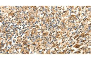 Immunohistochemistry of paraffin-embedded Human gastric cancer using SLC25A11 Polyclonal Antibody at dilution of 1:30 (SLC25A11 Antikörper)