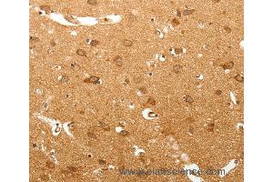 Immunohistochemistry of Human lung cancer using MAP1B  Polyclonal Antibody at dilution of 1:60 (MAP1B Antikörper)