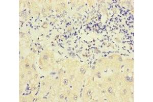 Immunohistochemistry of paraffin-embedded human liver cancer using ABIN7162443 at dilution of 1:100 (P2RX3 Antikörper  (AA 44-317))