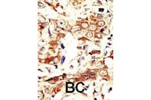 Formalin-fixed and paraffin-embedded human cancer tissue reacted with INSRR polyclonal antibody  , which was peroxidase-conjugated to the secondary antibody, followed by AEC staining. (INSRR Antikörper  (C-Term))