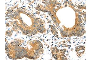 The image on the left is immunohistochemistry of paraffin-embedded Human colorectal cancer tissue using ABIN7192977(UBTD1 Antibody) at dilution 1/30, on the right is treated with synthetic peptide. (UBTD1 Antikörper)