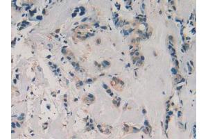 IHC-P analysis of Human Breast Cancer Tissue, with DAB staining. (AZGP1 Antikörper  (AA 180-298))