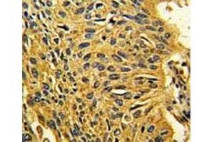 IHC analysis of FFPE human lung carcinoma stained with CDK2 antibody (CDK2 Antikörper  (AA 230-260))