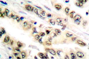 Immunohistochemical analysis of E2F4/E2F5 polyclonal antibody  in paraffin-embedded human lung carcinoma tissue. (E2F4 Antikörper)