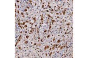 Immunohistochemistry (Formalin/PFA-fixed paraffin-embedded sections) of human placenta with PRICKLE1 polyclonal antibody  shows strong nuclear and cytoplasmic positivity in decidual cells.