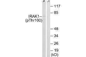 Immunohistochemistry analysis of paraffin-embedded human colon carcinoma tissue using IRAK1 (Phospho-Thr100) antibody. (IRAK1 Antikörper  (pThr100))
