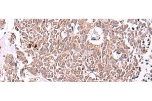 Immunohistochemistry of paraffin-embedded Human lung cancer tissue using IRX4 Polyclonal Antibody at dilution of 1:40(x200) (IRX4 Antikörper)