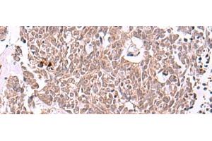 Immunohistochemistry of paraffin-embedded Human lung cancer tissue using IRX4 Polyclonal Antibody at dilution of 1:40(x200)