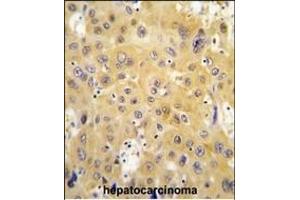 Formalin-fixed and paraffin-embedded human hepatocarcinoma tissue reacted with ECGF1 antibody (Center) (ABIN391460 and ABIN2841435) , which was peroxidase-conjugated to the secondary antibody, followed by DAB staining. (Thymidine Phosphorylase Antikörper  (AA 318-345))